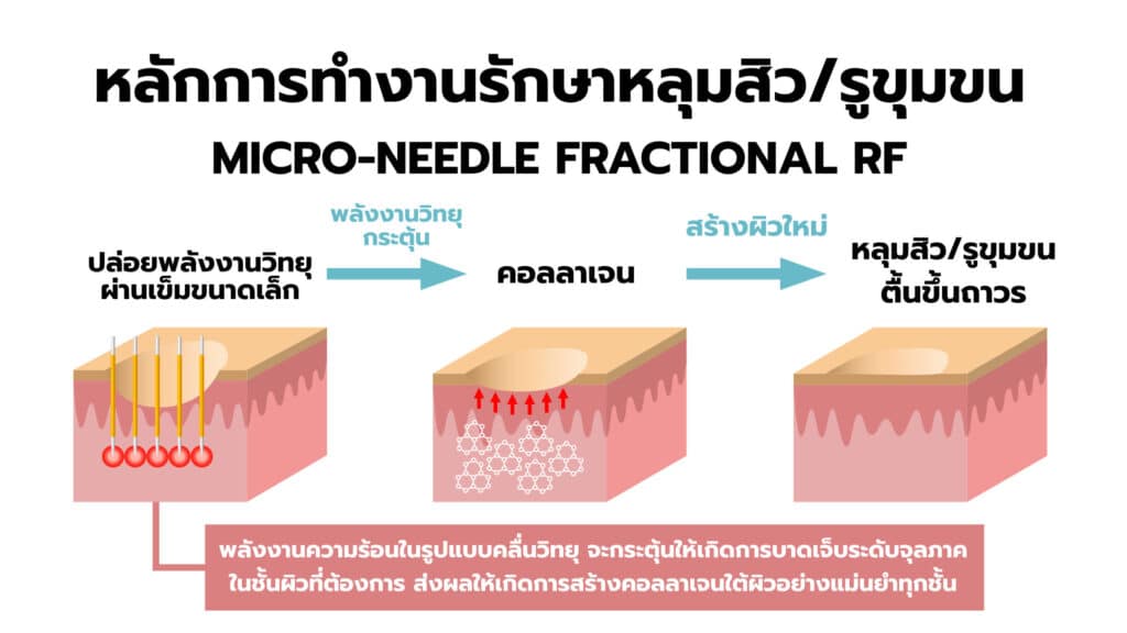 รักษาหลุมสิว micro-needle rf