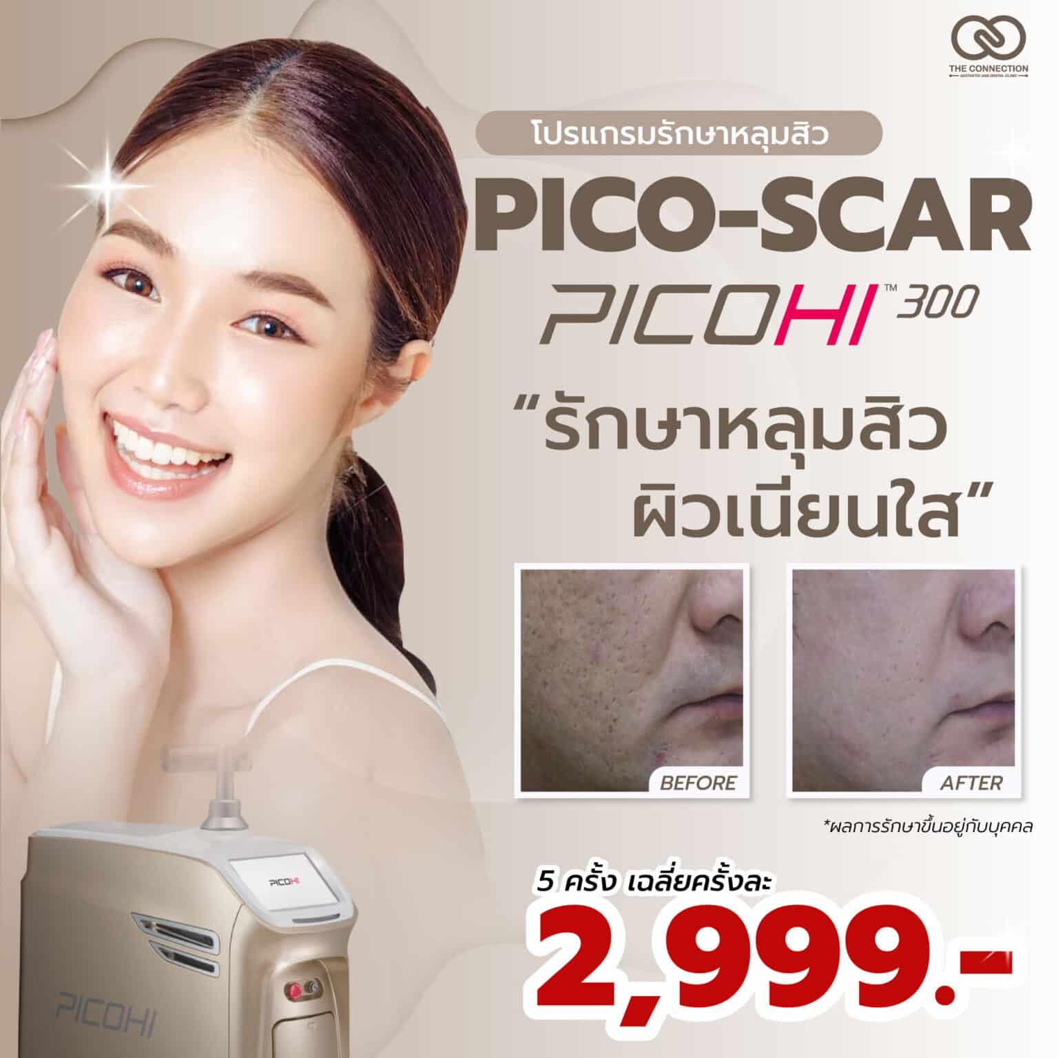 Pico laser ภูเก็ต